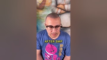 Insane SMP Transformation 🤯 #shorts #scalpmicropigmentation #hairloss #micropigmentation #smp