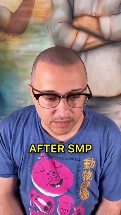 Insane SMP Transformation 🤯 #shorts #scalpmicropigmentation #hairloss #micropigmentation #smp