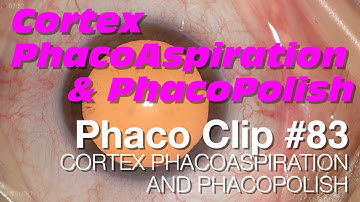 Phaco Clip #83 - Cortex PhacoAspiration and PhacoPolish
