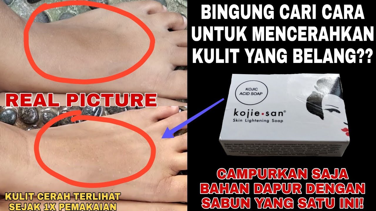 CARA AMPUH MEMUTIHKAN KULIT BELANG (KULIT TANGAN,KAKI