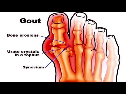 How to Lower Uric Acid to Get Rid of Gout in 1 Week | CURE GOUT - YouTube
