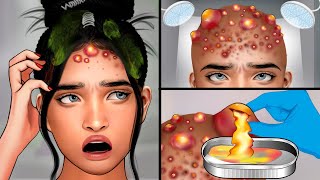 ASMR Head Acne Removal and Pimples Popping | Itchy Scalp Treatment ASMR screenshot 5