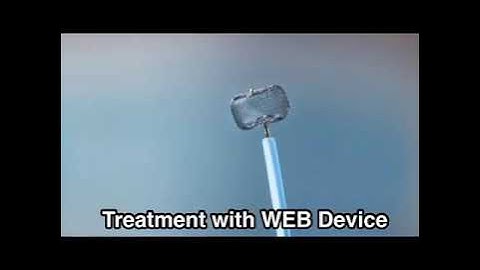 Aneurysm Treatment with WEB Device