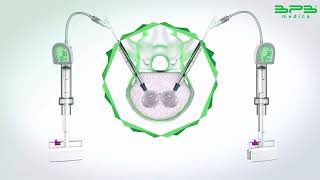 RENOVA SPINE™ 11G: Kyphoplasty kit for fast approach