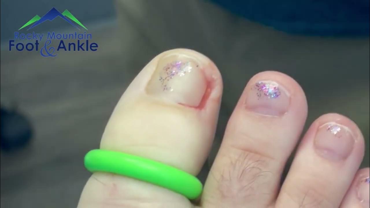 Satisfying Ingrown Toenail Removal YouTube