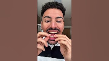 Week 3 of 14 invisalign trays