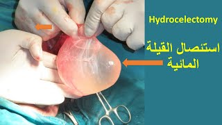 Hydrocelectomy استئصال القيلة المائية