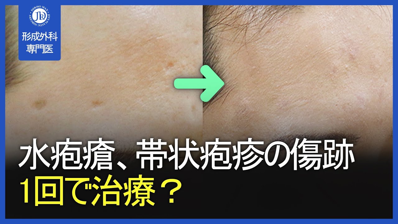 【日本字幕付】水疱瘡、帯状疱疹の傷跡の原因から1度に治療する方法まで - YouTube