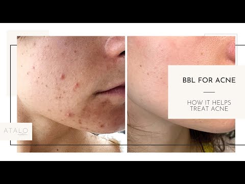 How to Get Rid of Acne with BBL!