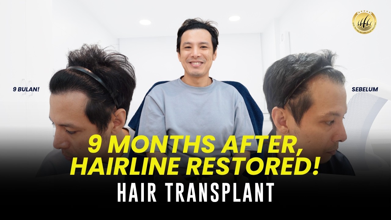 9 Months Post-SMART™ FUE: Hair Transformation Journey at GLOJAS #hairtransplantmalaysia