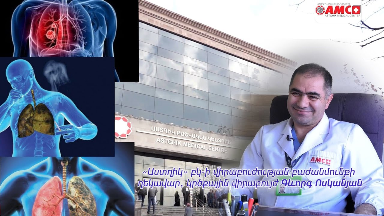 «Աստղիկ» բկ-ում ժամերի ընթացքում ախտորոշում ենք թոքի քաղցկեղը առաջնային փուլում