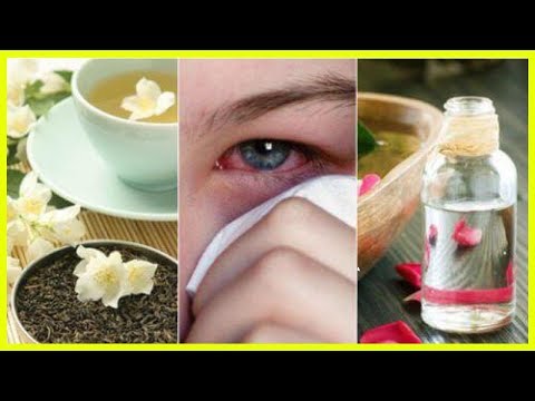 Video: Hausmittel Gegen Augeninfektionen: 6 Methoden