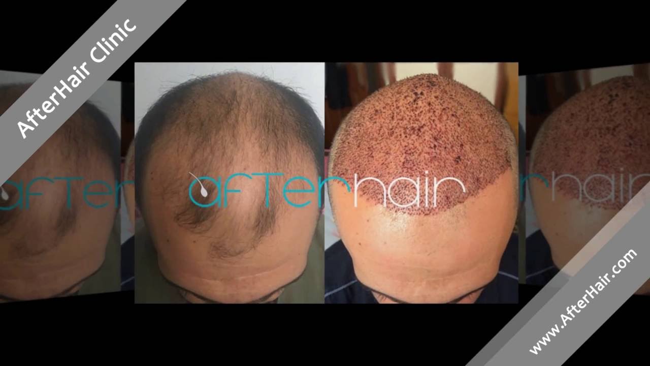 Goodbye To Baldness 4500 Graft Hair Transplant In Turkey Afterhair Com Clinic Youtube