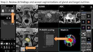 Artificial Intelligence software for Prostate Cancer Detection - case-based review