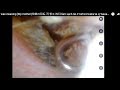 Ear wax cleaning (My mother)母親の耳垢 귀 청소 洗耳 làm sạch tai การทำความสะอาด หู Ушная сера