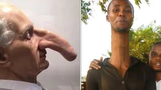 Top 10 People With Bigger Then Normal Body Parts