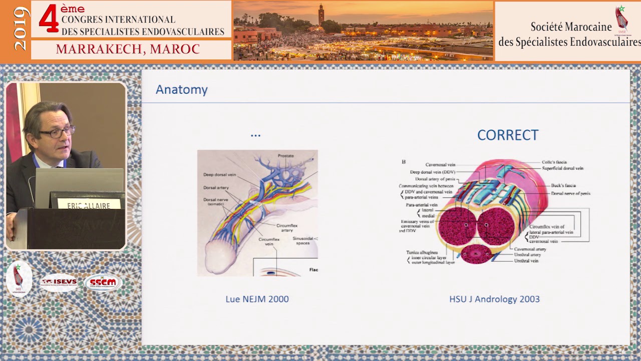 Nouveaux domaines de l’Endovasculaire : Traitement de la dysfonction érectile par fuite veineuse