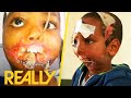 Ethiopian Boy Gets Miraculous Jaw Reconstruction Surgery After Hyena Attack | Body Bizarre