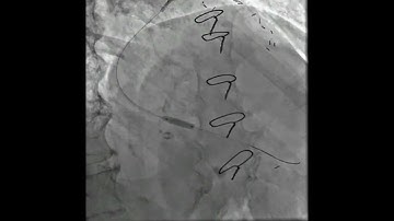 MV PCI POST CABG PATIENT