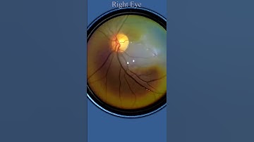 Retinal Fundus Recording | Smartphone Fundus camera