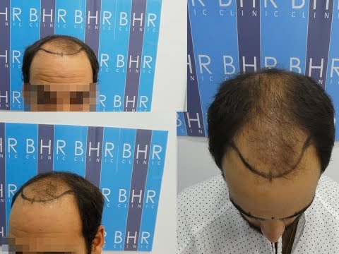 Tecnica FUE | Extracción capilar BHR CLINIC SPAIN