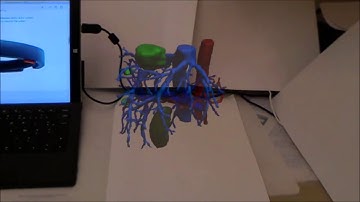 IRCAD - Visible Patient - Hololens AR Visualisation of patient
