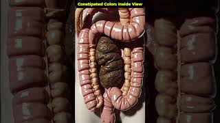 #constipation