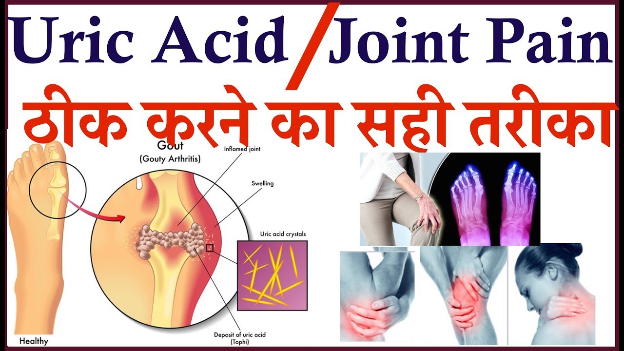 Uric Acid & Joint Pain ठीक करने का सही तरीका Gout And Arthritis Treatment YouTube