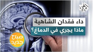 ماذا يجري في دماغ المصابين بداء فقدان الشهية؟ وما تأثيراته عليهم؟