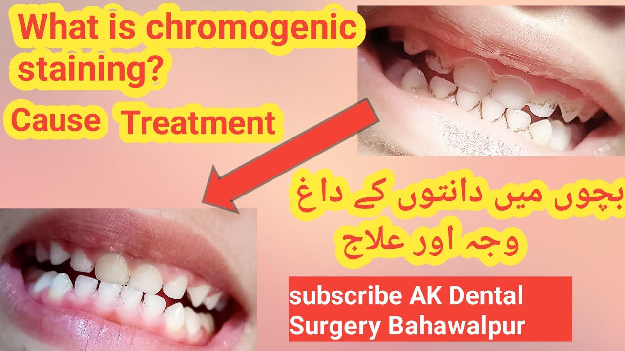 chromogenic-staining-chromogenic-bacteria-milk-teeth-stain-baby