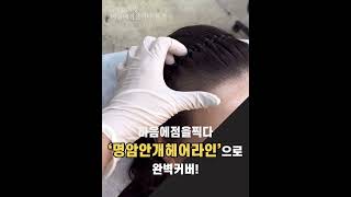 광주두피문신/광주smp/광주두피문신수강/여성 헤어라인 ‘M자모양’교정! #smp #두피문신 #두피문신가격 #반영구 #smp두피문신 #hairloss #탈모 #脱发