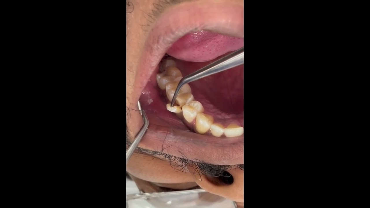 Tooth Fracture Broken Fyp Video Foryou Tiktok Viral Trending Love