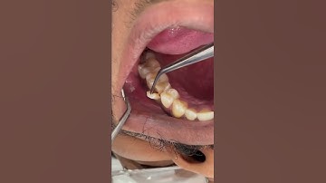 tooth fracture #broken #tooth#fyp #video #foryou #tiktok #viral #tiktok #trending #love #foryou