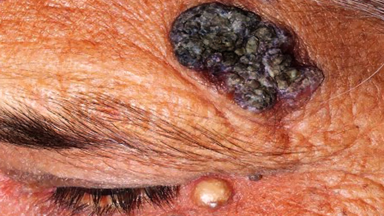 Dilated Pore of Winer vs Blackheads vs Solar Comedones - YouTube