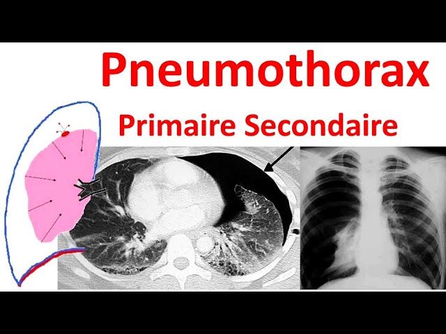 Pneumothorax spontané primitif secondaire Radiologie douleur thoracique  traitement Anatomie plèvre
