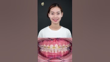 Răng khểnh chỉ còn là quá khứ vì đã có niềng răng công nghệ ABM #shost