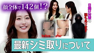 【取り放題】ぜんぶで142個!顔のシミを取って明るい印象に!!シミの天敵、日焼け対策についてもお話します!
