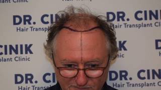 Dr Cinik Hairtransplant Clinic 6300 Grafts In 9 Months Hair Transplant Dr Emrah Cinik