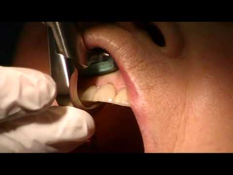 Tim Kosinski - Physics Forceps Tooth Extraction, dental implants