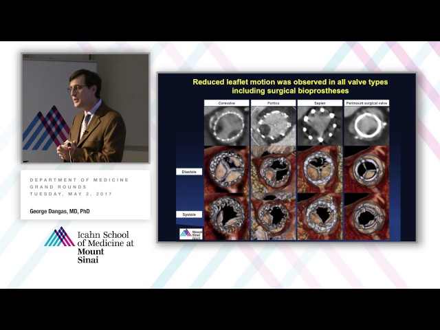 Neurological Outcomes & Dilemmas in the Settings of Aortic Valve Replacement