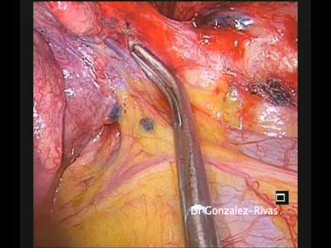 Uniportal thoracoscopic anatomic lingulectomy lung tumor (15 minutes,not edited, real speed)