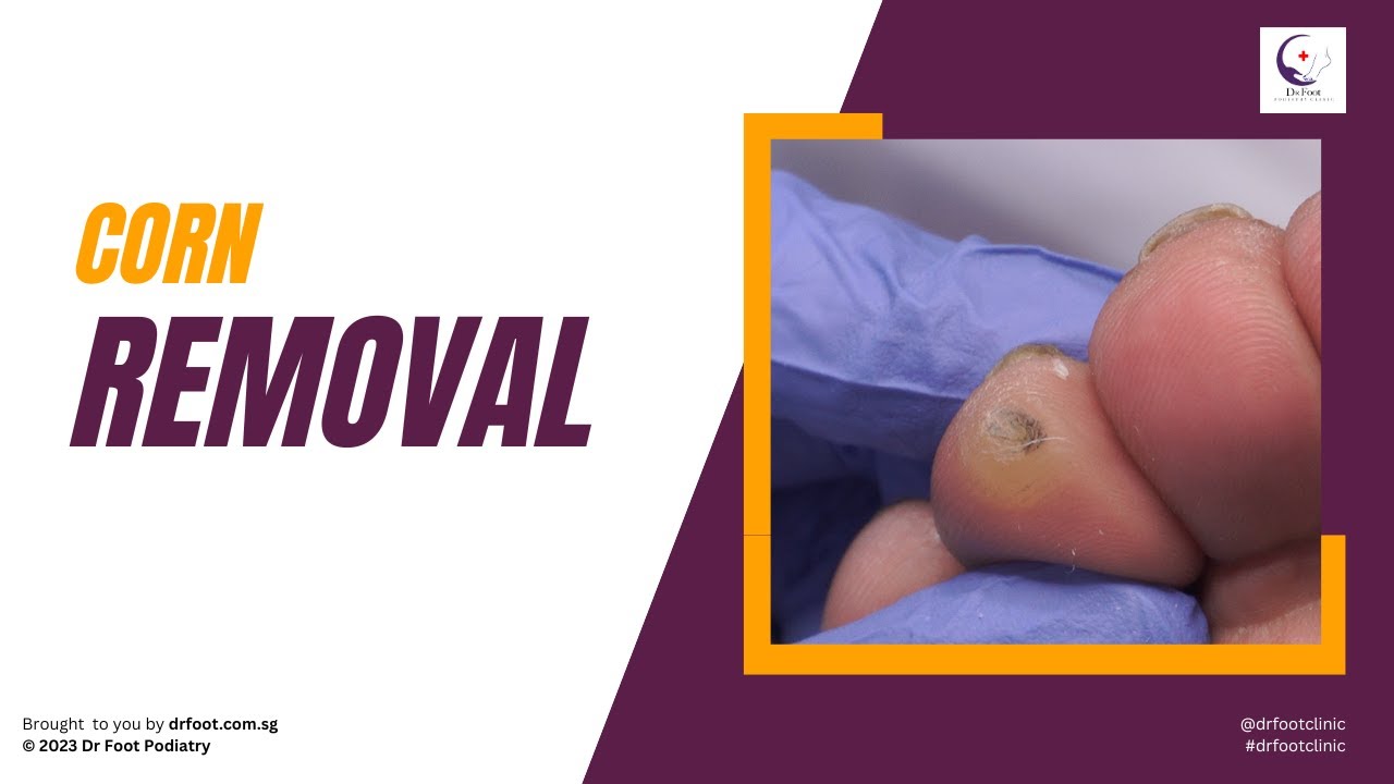 MULTIPLE CALLUSES AND CORN REMOVAL! - YouTube