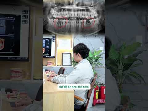 Cấy trụ implant răng không đau | trồng implant phục hình răng | tư vấn tốt nhất từ nha khoa Asia