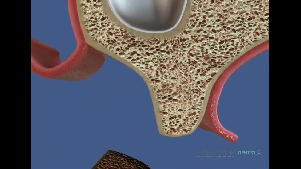 Пересадка кости. Костная пластика собственной костью. Пересадка собственной костной ткани. Узура кости стоматология. Аутотрансплантация кости в стоматологии.
