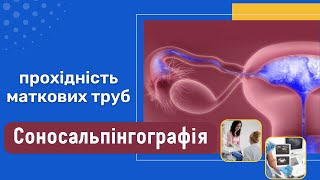 Не можете завагітніти? Все, що потрібно знати про ССГ (Соносальпінографію)