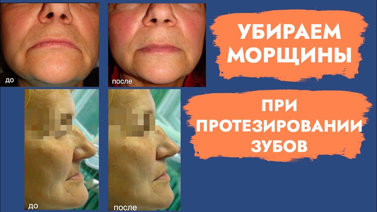 Устраняем морщины при изготовлении съемных протезов. - YouTube