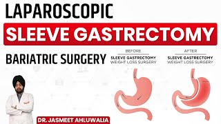 Sleeve Gastrectomy Hindi | Best Bariatric Surgery | Most Popular Weight Loss Surgery | Punjab India