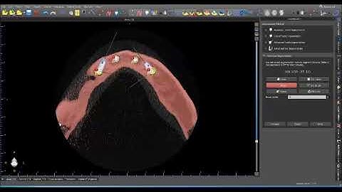 SegmentedJaw before guide fabrication