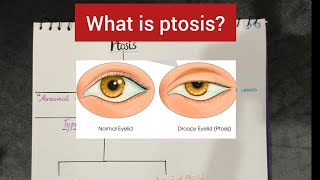 Ptosisdropping Eyelid