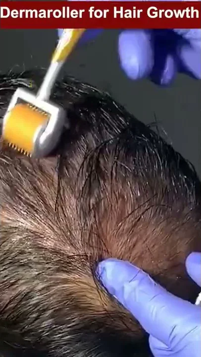 Will Using the Derma Roller on Scalp Increase Hair Growth